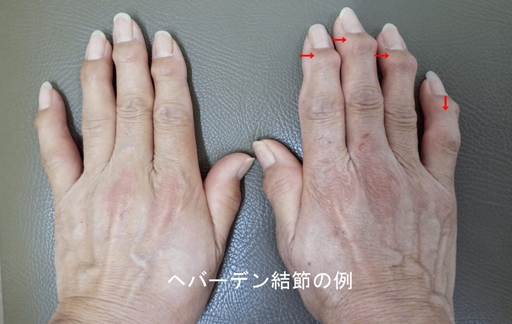 へバーデン結節の治療なら、土日も診療の愛知県一宮市「みらいウェルネスクリニック」へご相談ください